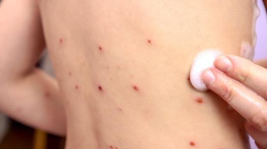 تسجيل انخفاض متواصل في حالات الإصابة بفيروس الحصبة للأسبوع الخامس على التوالي