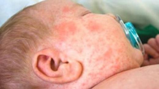 منظمة الصحة العالمية تحذر من عودة انتشار مرض “بوحمرون” في المغرب