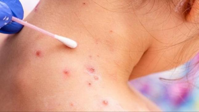 جدري القردة .. ثلاث حالات يشتبه في إصابتها بالمغرب..