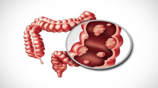 4 علامات حمراء مبكرة تشير لسرطان القولون والمستقيم..