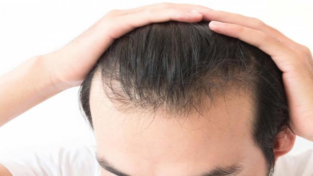 دراسة: يمكن أن يتنبأ شعرك بقرب إصابتك بحالتين قاتلتين..￼￼￼￼ ￼