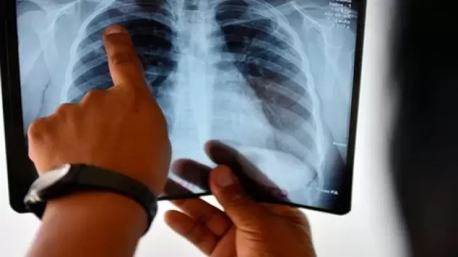 القلق المتزايد من حالات الإصابة بداء السل اللمفاوي في عدد من المناطق يصل إلى البرلمان