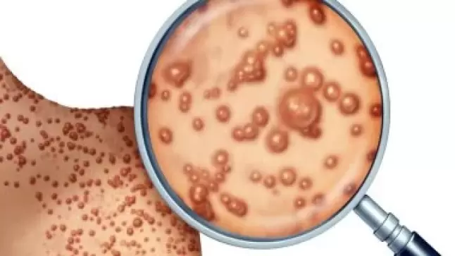 جدري القرود يعود إلى الواجهة ومنظمة الصحة العالمية تُحذر..