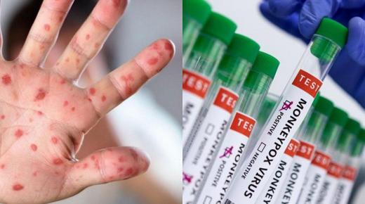 جدري القرود.. انتقال العدوى والأعراض والعلاج..