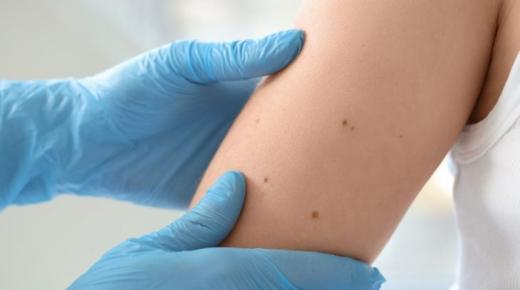 أكثر من 80% من الإصابات بسرطان الجلد تعزى إلى الأشعة فوق البنفسجية..