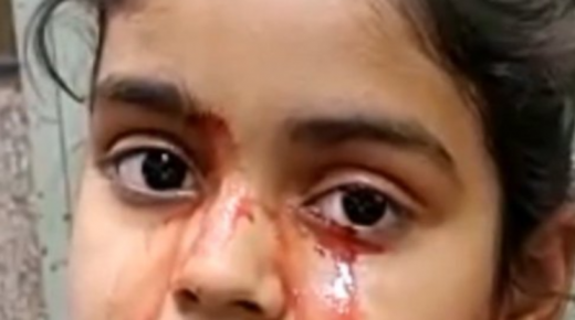 في حالة طبية نادرة تربك الأطباء.. طفلة تبكي دما..