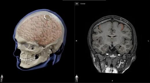 أول مريض تُزرع شريحة بدماغه ينجح في التحكم بفأرة كمبيوتر من خلال تفكيره