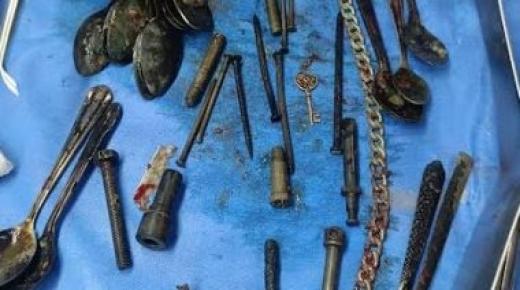 اكتشاف ملاعق ومسامير وموس حلاقة في معدة رجل￼