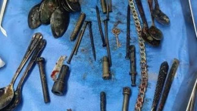 اكتشاف ملاعق ومسامير وموس حلاقة في معدة رجل